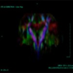 Brain Surgery