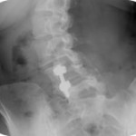 Spine Surgery